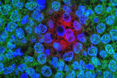 追踪抗性乳腺癌细胞可能会导致新疗法