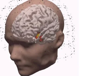 新型非侵入性脑部扫描技术为癫痫患者带来新的生命